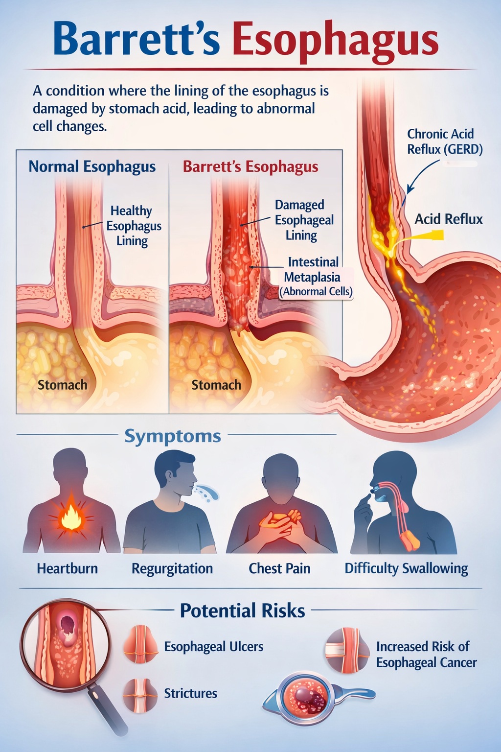 Barrett's Esophagus.jpg